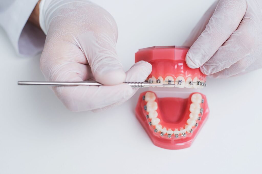 Hands in white gloves poking braces on model teeth